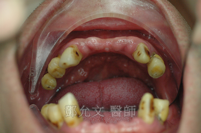 下顎中門齒牙周病即拔即種，補骨及組織引導再生修補 