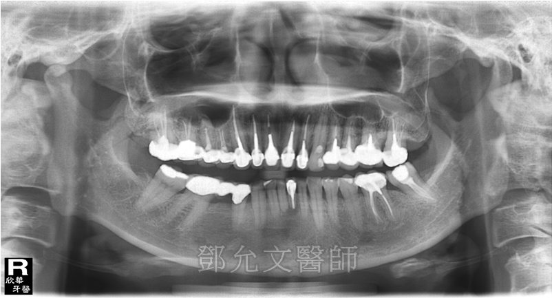 病患求診時x光片