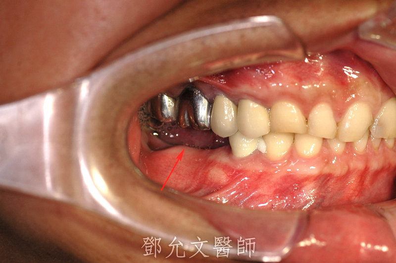 第一次植牙手術前，口內照(右下後牙缺牙區側面照)