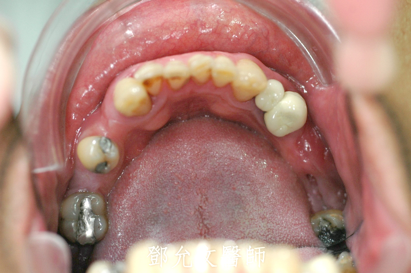 根尖膿腫補骨植牙