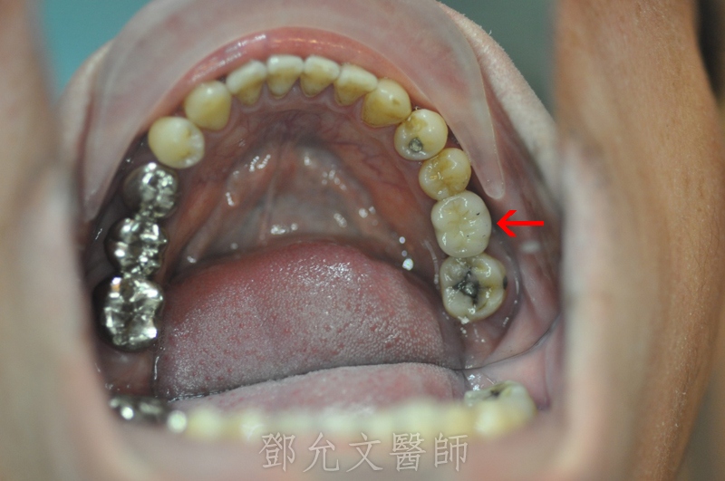 牙周病植牙，上顎竇增高術(Sinus Lifting)，上顎前牙即拔即種及補骨(GBR)