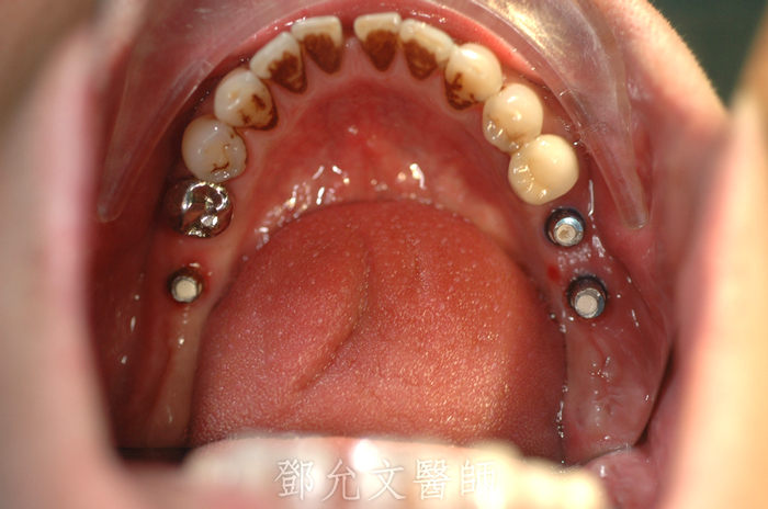 左側牙橋急性牙髓炎，拔除後與右側一併人工植牙