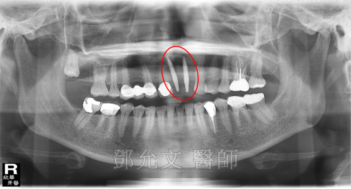 骨性龅牙侧面x光片图片
